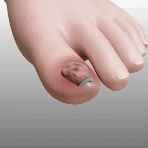Reparador para Uñas Fungus